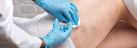Non-Surgical Vein Treatments That Get You Back on Your Feet Fast